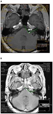 Analysis of risk factors related to the progression rate of hemifacial spasm